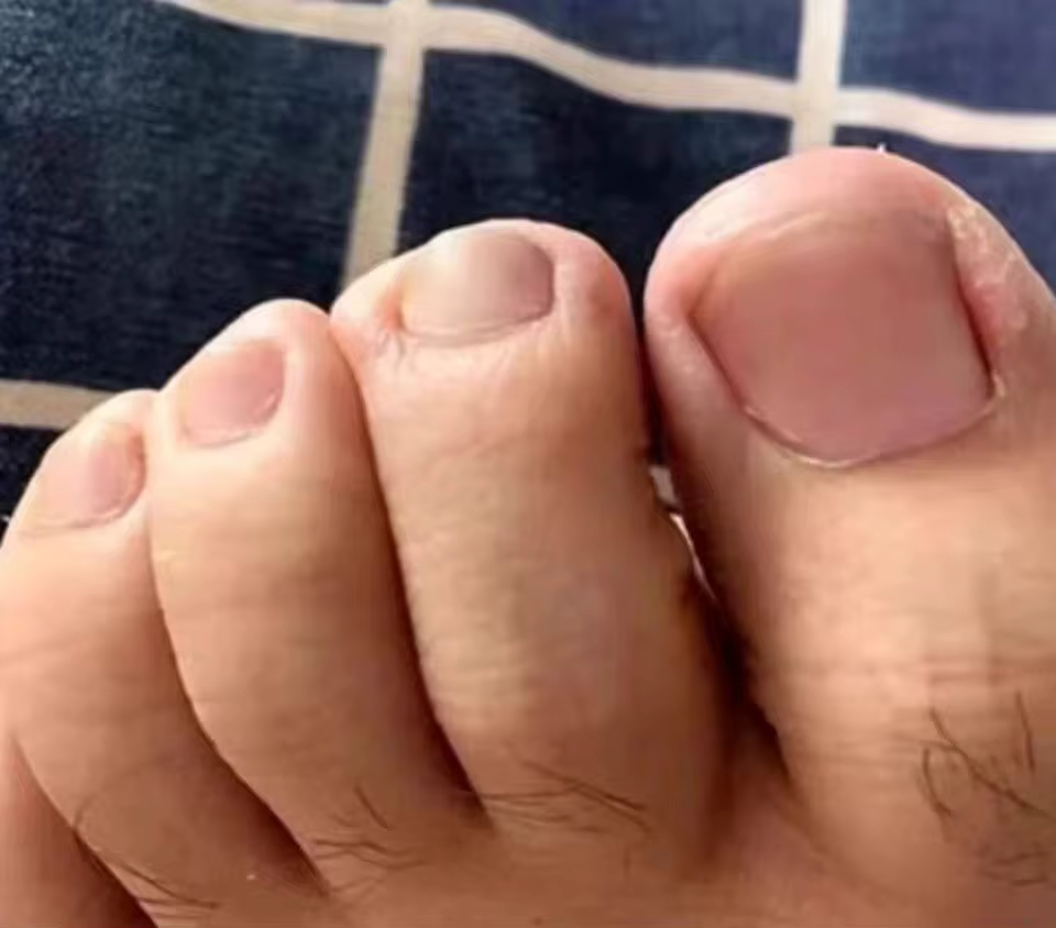 Después del tratamiento