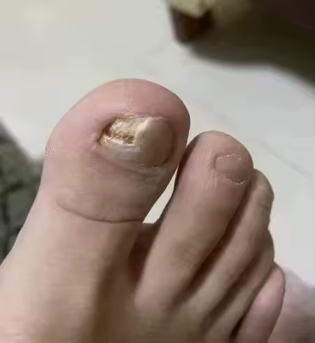 Antes del tratamiento